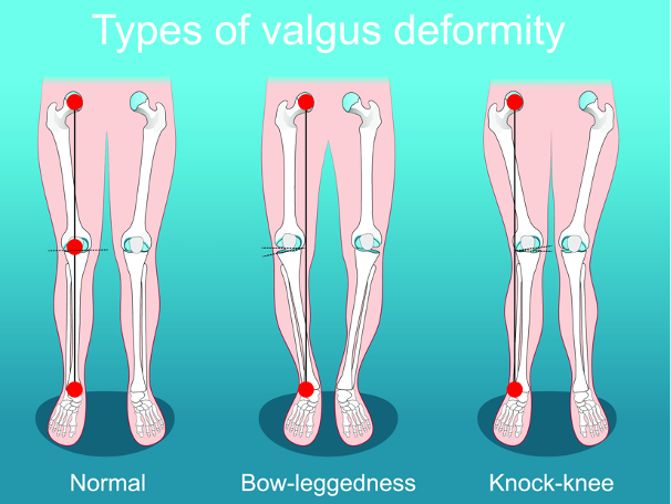 Osteotomie voor ascorrectie van de knie